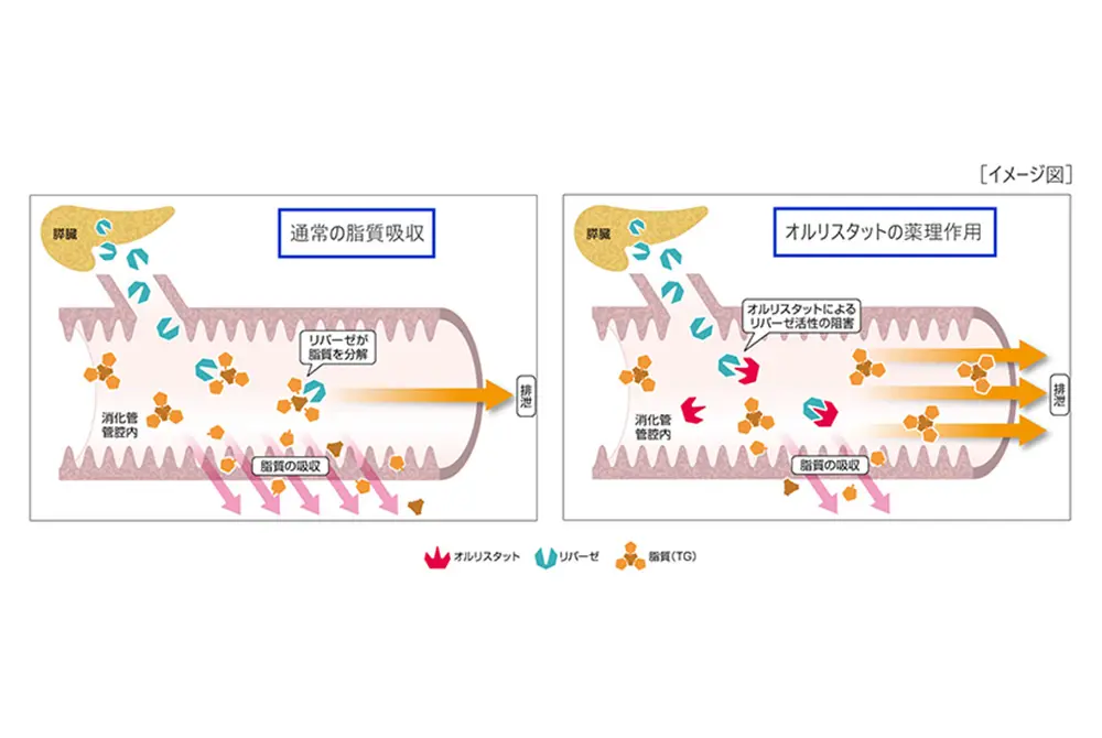 脂肪の分解を邪魔して、脂肪の吸収を抑える。（出典／大正製薬）