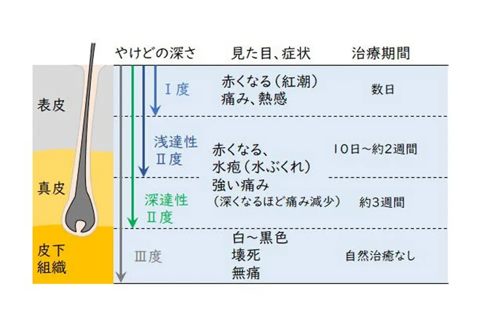 ヤケドの程度はI度からIII度に分類される。（写真／国民生活センター）