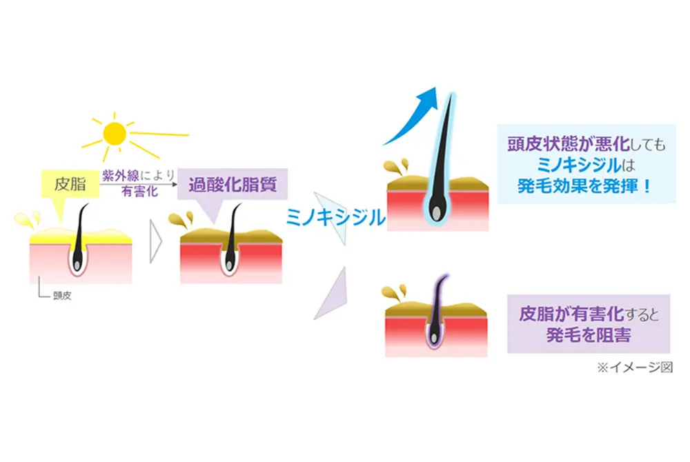 紫外線により発生する過酸化脂質の影響と、その条件でのミノキシジルの効果を確かめた。（出典／大正製薬）