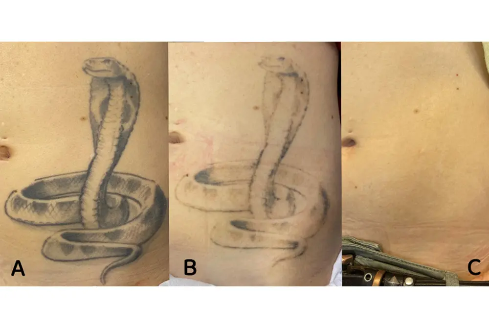 レーザーにより黒色のタトゥーを除去。(出典/J Cosmet Dermatol. 2025;24:e70186.)