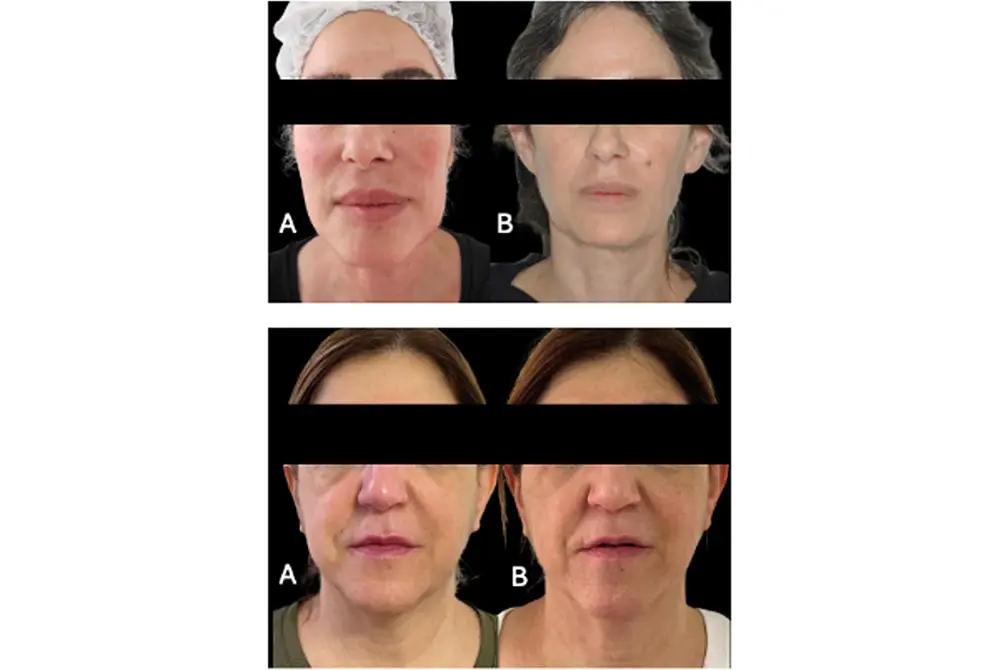 ヒアルロン酸注入を受けた後の顔面オーバーフィルド症候群。（出典／J Cosmet Dermatol. 2025 Aug;24(8):e70377.）