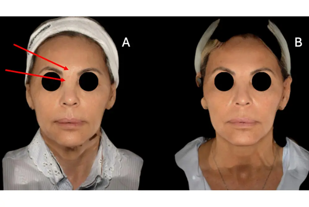 ヒアルロン酸注入を受けたほか、シリコンも注入した後の顔面オーバーフィルド症候群。（出典／J Cosmet Dermatol. 2025 Aug;24(8):e70377.）