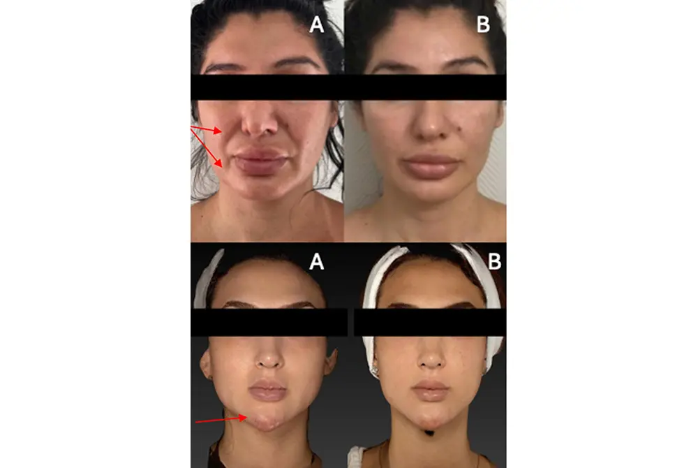 脂肪注入（上）、シリコン注入（下）を受けた顔面オーバーフィルド症候群。（出典／J Cosmet Dermatol. 2025 Aug;24(8):e70377.）