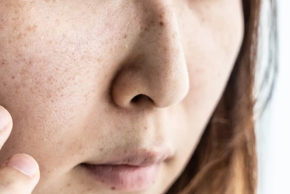 手強い肝斑。画像はイメージ。（写真／Adobe Stock）