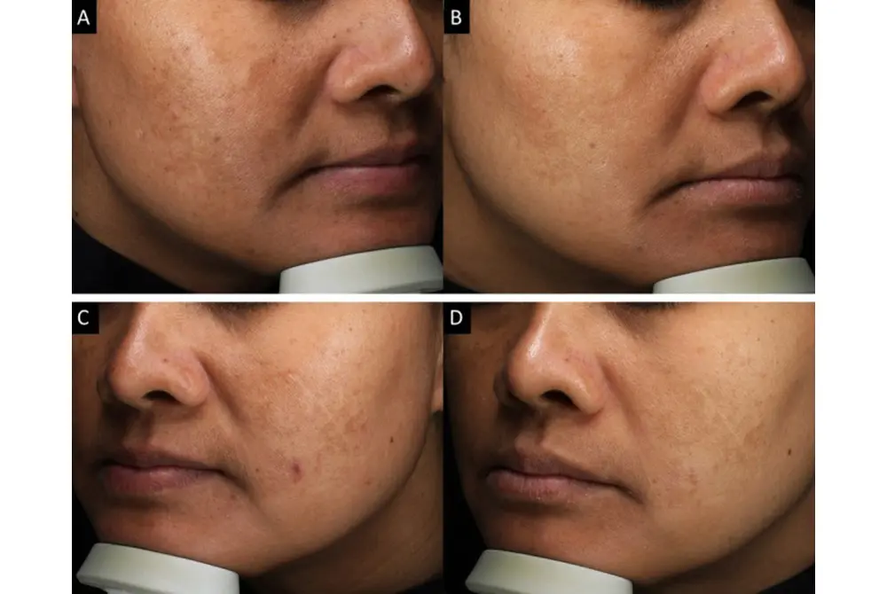 肝斑の改善が認められた。上はボツリヌス療法と塗り薬を組み合わせた治療。下は塗り薬のみ。左が治療前、右が治療後。（出典／J Cosmet Dermatol. 2025 Aug;24(8):e70376.）