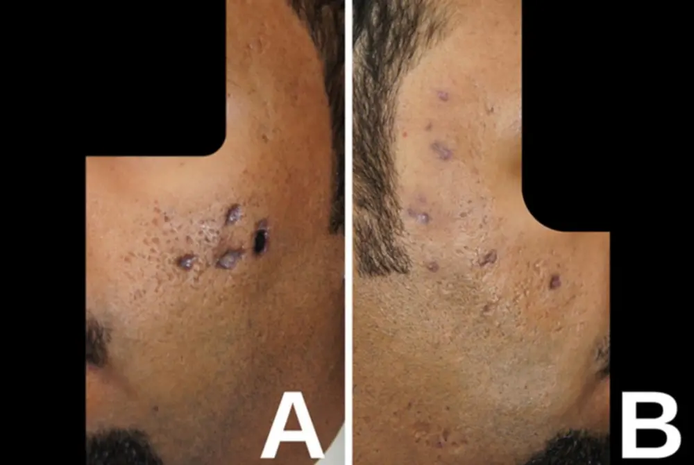 両頬に壊死や色素の沈着が起きた。Aは左の顔面、Bは右の顔面。（出典／J Cosmet Dermatol . 2025;24:e70387. ）