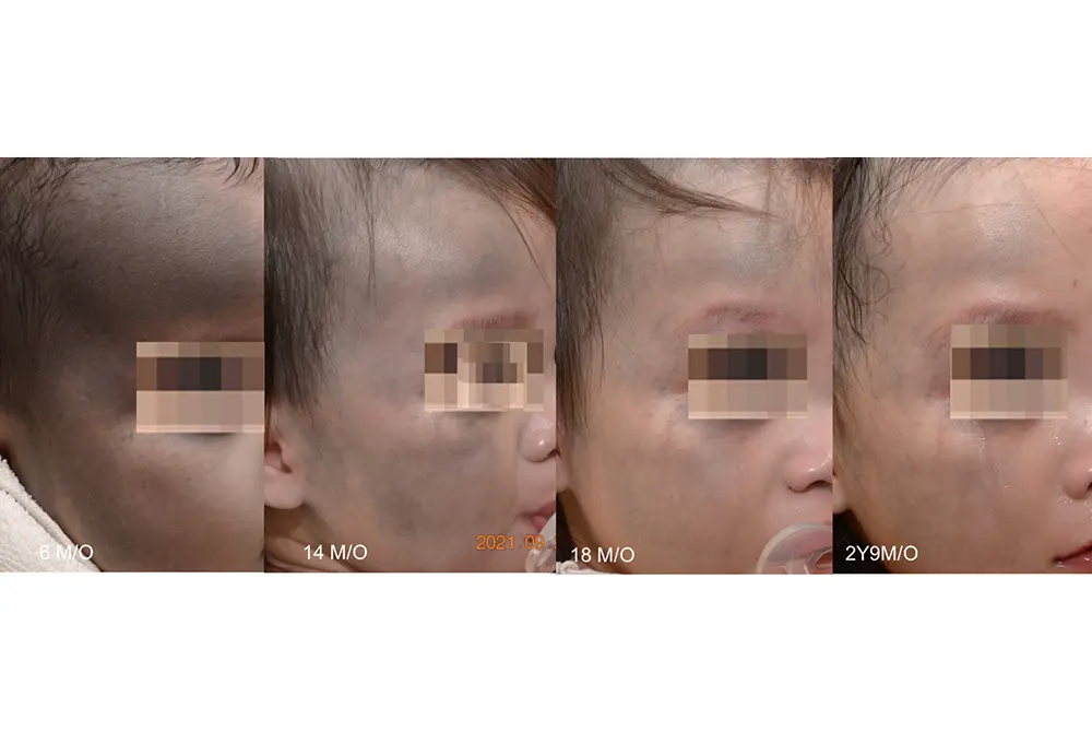 太田母斑をフラクショナルQスイッチルビーレーザーで治療。１番左が6カ月時点。1番右が2歳9カ月。（出典／Journal of Cosmetic Dermatology. First published: 12 August 2025.）