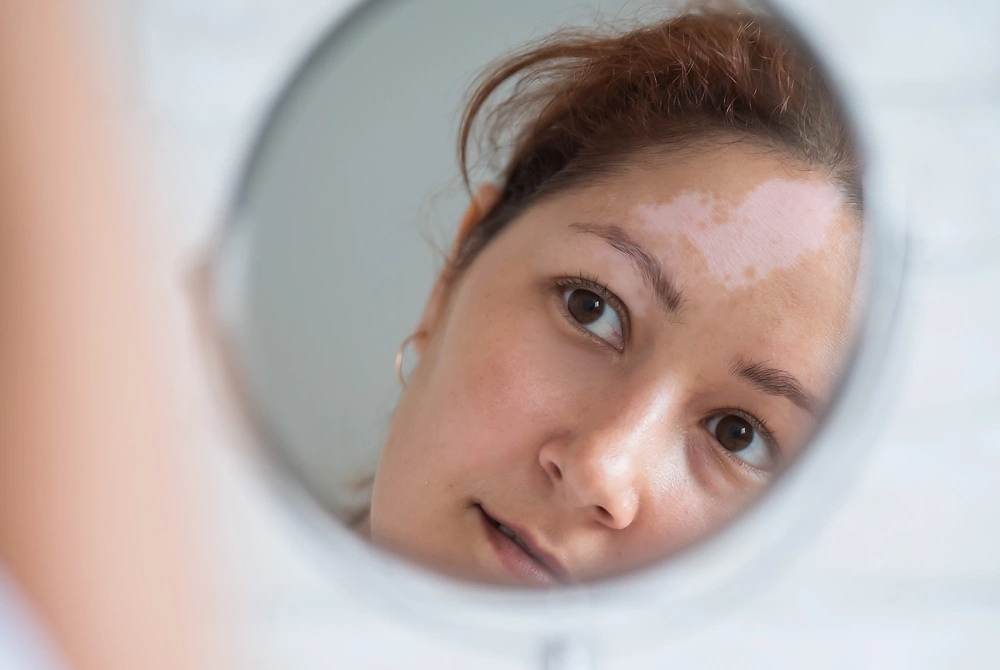 顔にみられる白斑の状態を確認する女性。画像はイメージ。（写真：Adobe Stock）