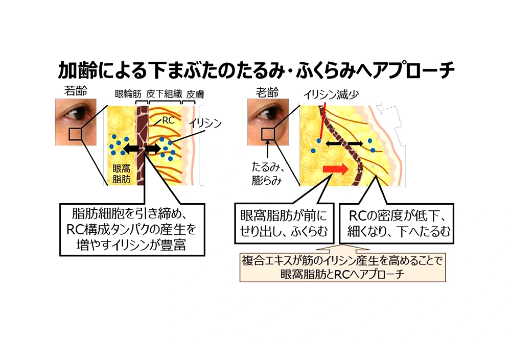 加齢により下まぶたの皮膚支持帯が細くなり、眼窩脂肪が前にせり出して目袋が生じる仕組みを示した図。