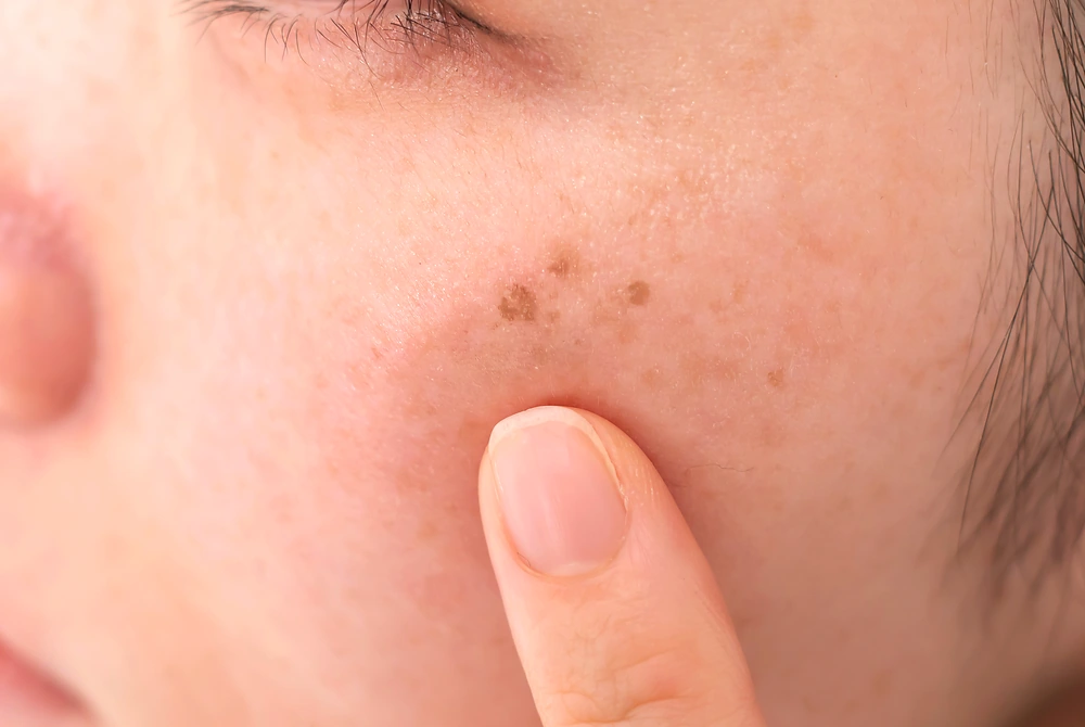 頬の茶色いシミや色素斑を指で確認している顔のアップ。