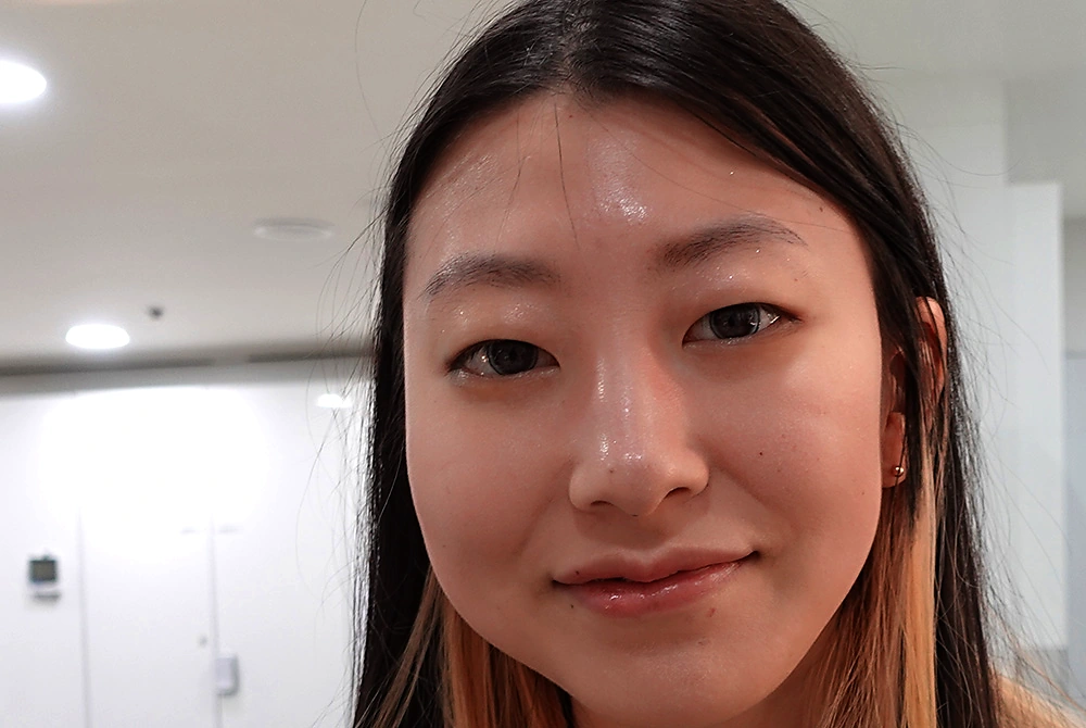 黒目を大きく見せる眼科インプラントの見た目を示す、BEAUEYE VISIONイ氏の娘。