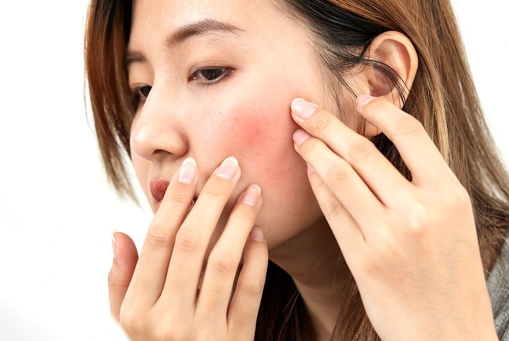 頬に赤みが出た部分を指で確認する女性の横顔。