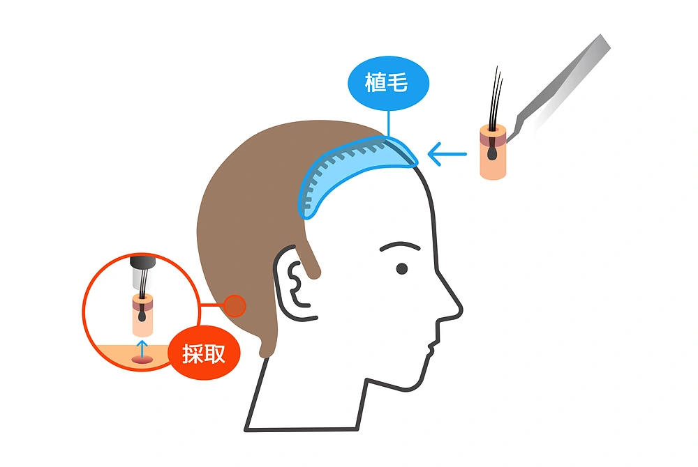 後頭部から毛髪を採取し、前頭部へ植毛する流れを示した模式図。