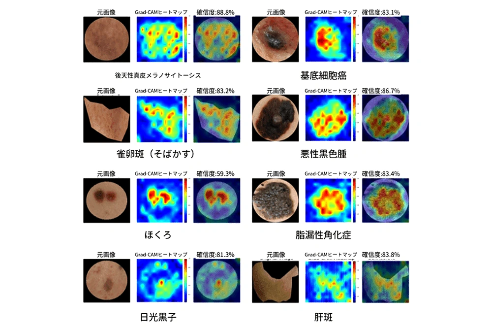 8種類の色素性皮膚病変について、元画像とAIの注目部位を示すヒートマップを並べた図。