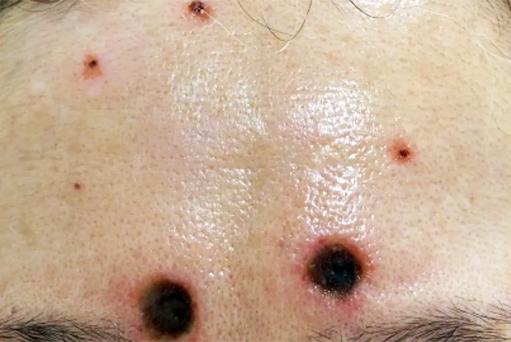 70代女性の額にクリームが皮膚障害を起こした。（出典／国民生活センター）