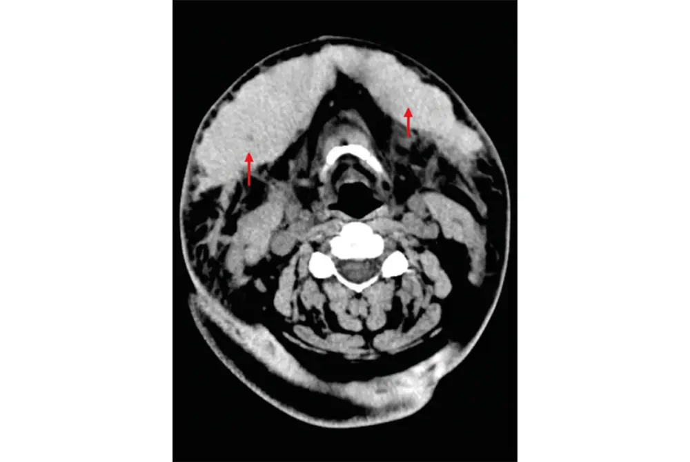 CT検査の写真。矢印が示している白い部分は血液がたまったところ。（出典／Med Oral Patol Oral Cir Bucal. 2022 May; 27(3): e257–e264.）
