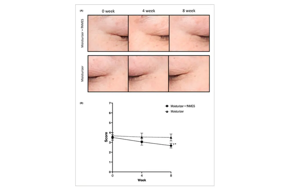 上は美容機器と保湿剤。下は保湿剤のみ。シワの改善が見られた。（出典／J Cosmet Dermatol . 2024 Jul 11. doi: 10.1111/jocd.16403. Online ahead of print.）