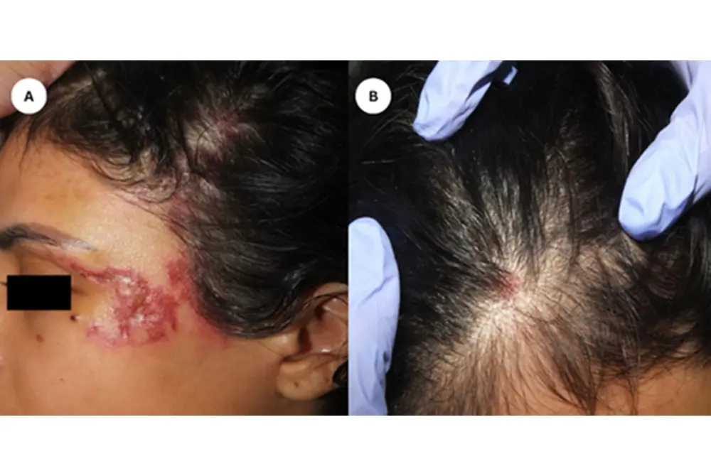 ヒアルロン酸フィラー注入の後、赤くただれる。（出典／J Cosmet Dermatol. 2024 Nov 20:e16684. doi: 10.1111/jocd.16684. Epub ahead of print.）