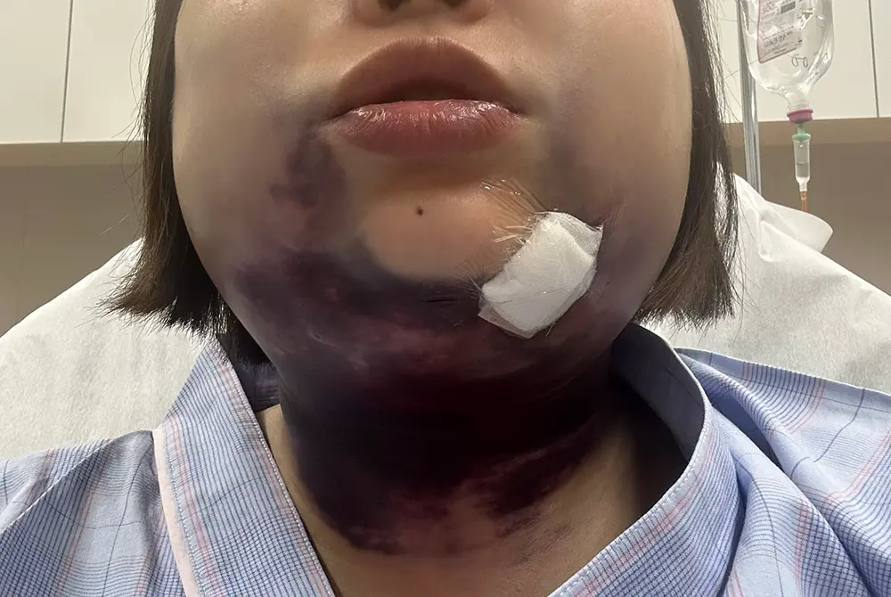 瀬戸さんが血腫発生の後に撮影した写真。（写真提供／瀬戸麻希さん）