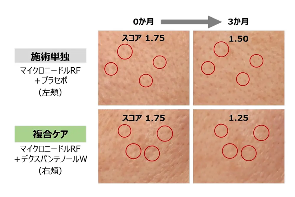 施術単独(上2枚)、施術+ホームケア(下2枚)の0カ月から3カ月の変化。(出典/ポーラ化成工業)