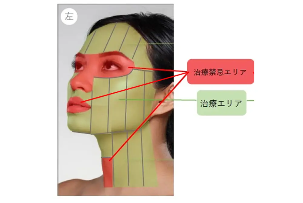 皮膚引締め用超音波照射器「Sofwaveシステム」適正使用指針で示された治療エリアと治療禁忌エリア 。(出典/日本美容外科学会=JSAPS、JSAS、日本美容皮膚科学会)