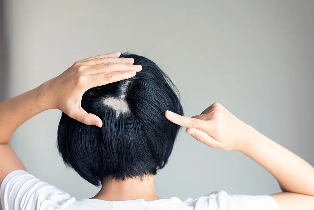 円形脱毛症。写真はイメージ。（写真／Adobe Stock）