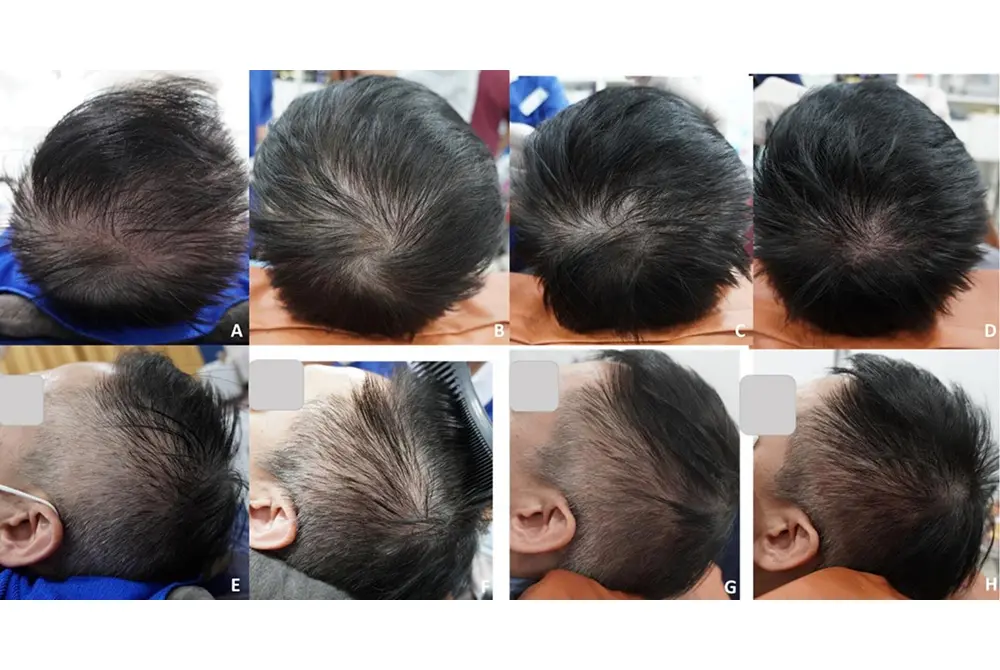 フラクショナル1064 nm Nd:YAGピコ秒レーザーとエレクトロポレーションによるエクソソーム導入を4週ごとに6回実施。黒髪の傾向が出ると共に毛量も増えた。（出典／J Cosmet Dermatol
. 2025;24:e70526.）