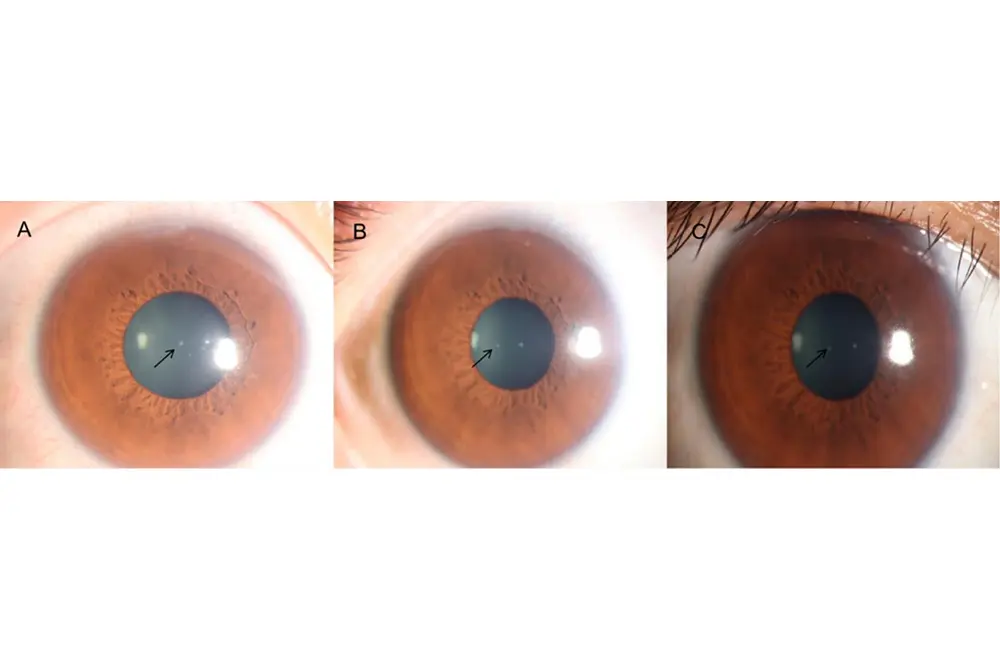 角膜に白い斑点が残った。矢印の部分。(出典/J Cosmet Dermatol. 2025;24(12):e70601.)