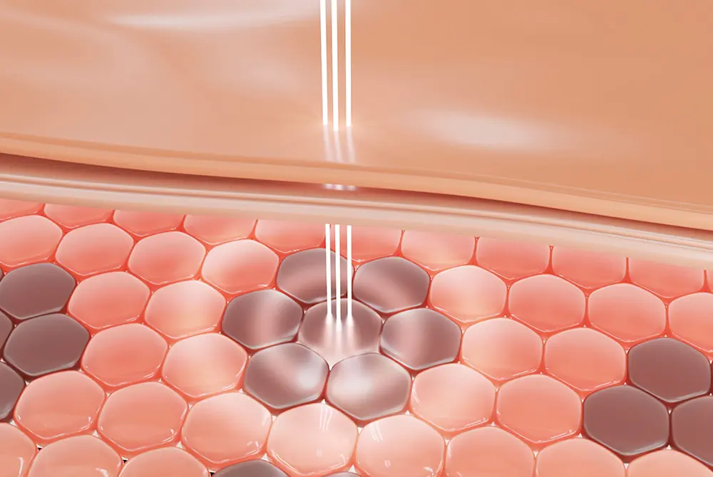 レーザー施術の機器で実績のある米国の企業。画像はイメージ。(写真/Adobe Stock)