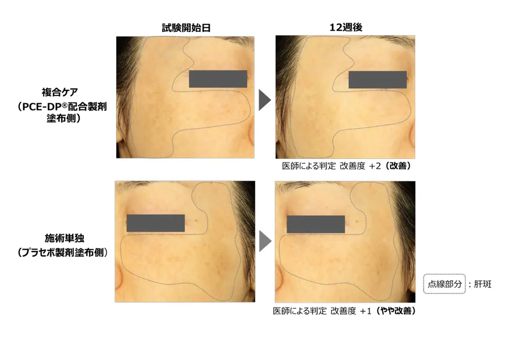 40代女性へのレーザートーニングの効果。上段は化粧品との連携あり。下段はなし。左が施術前で、右が12週間後。（出典／ポーラ化成工業）