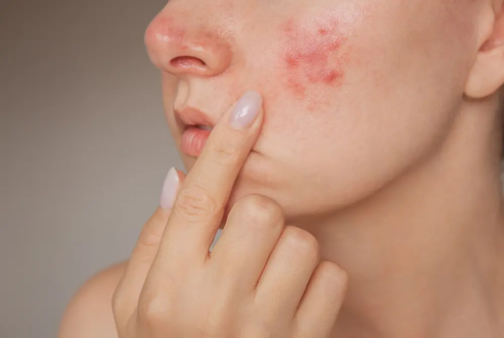 赤ら顔は治りにくいケースも。画像はイメージ。（写真／Adobe Stock）