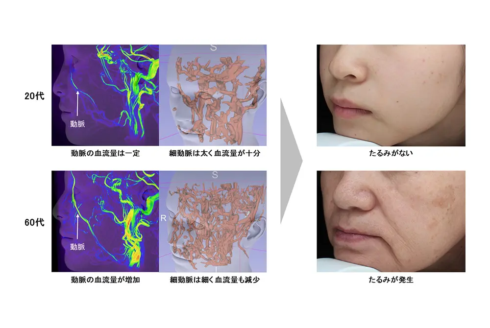 加齢に伴う深部血管の血流量の変化と、肌のたるみとの関係を示した図
