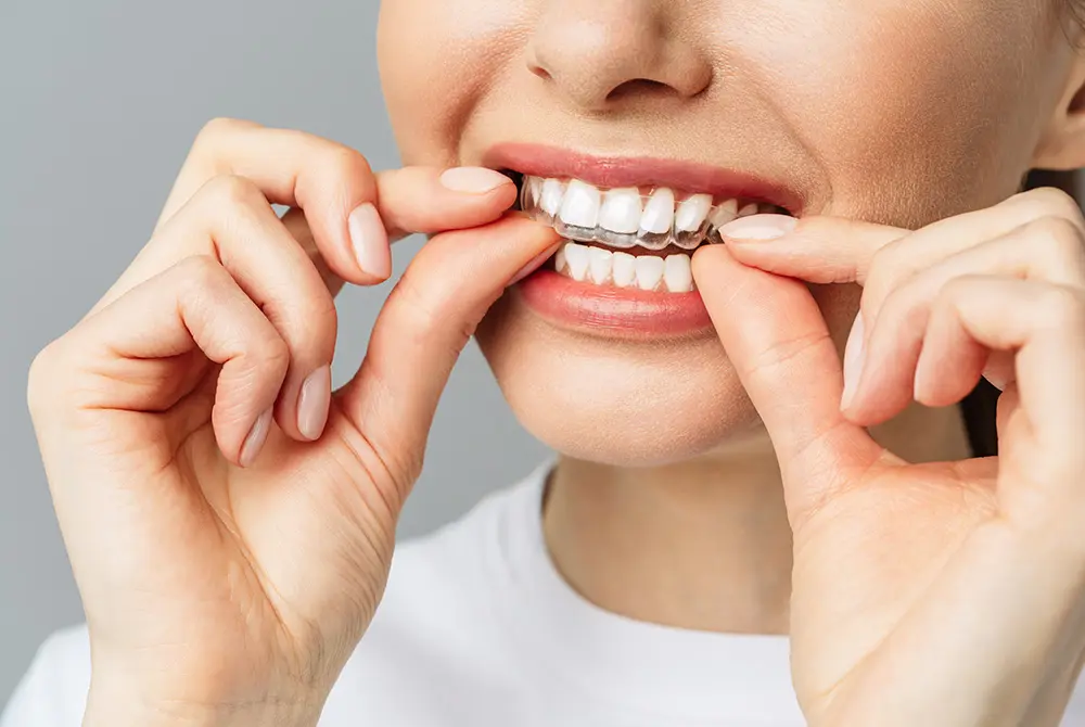 矯正歯科では、マウスピース矯正への関心が高い。画像はイメージ。（写真：Adobe Stock）
