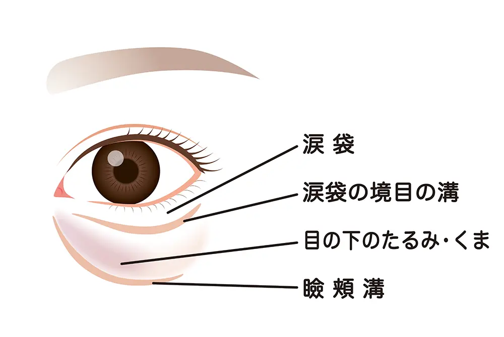 目の下のたるみ、溝の状態を見て、適切な手術法を判断する。写真はイメージ。（写真／Adobe Stock）
