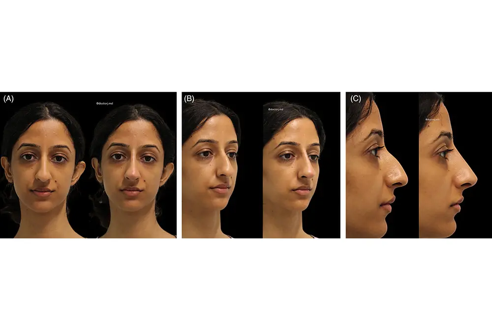 非外科的鼻形成術。26歳インド系の女性。（写真／J Cosmet Dermatol
. 2024 Feb;23(2):426-433.）