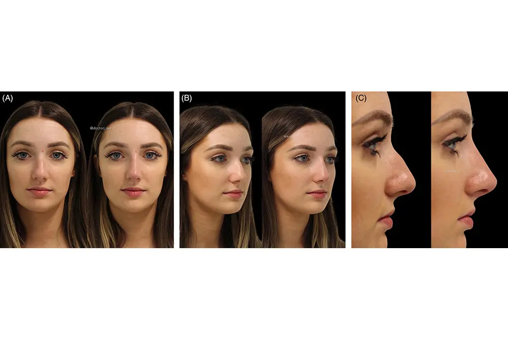 非外科的鼻形成術。23歳白人女性。（写真／J Cosmet Dermatol
. 2024 Feb;23(2):426-433.）