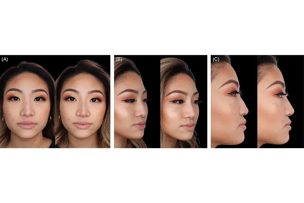 非外科的鼻形成術。26歳東アジア系女性。（写真／J Cosmet Dermatol . 2024 Feb;23(2):426-433.）