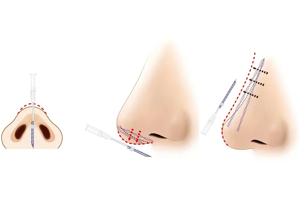 ボリューマイジングスレッドを使った隆鼻術。（出典／J Cosmet Dermatol . 2024 Sep 1. doi: 10.1111/jocd.16542. Online ahead of print.）