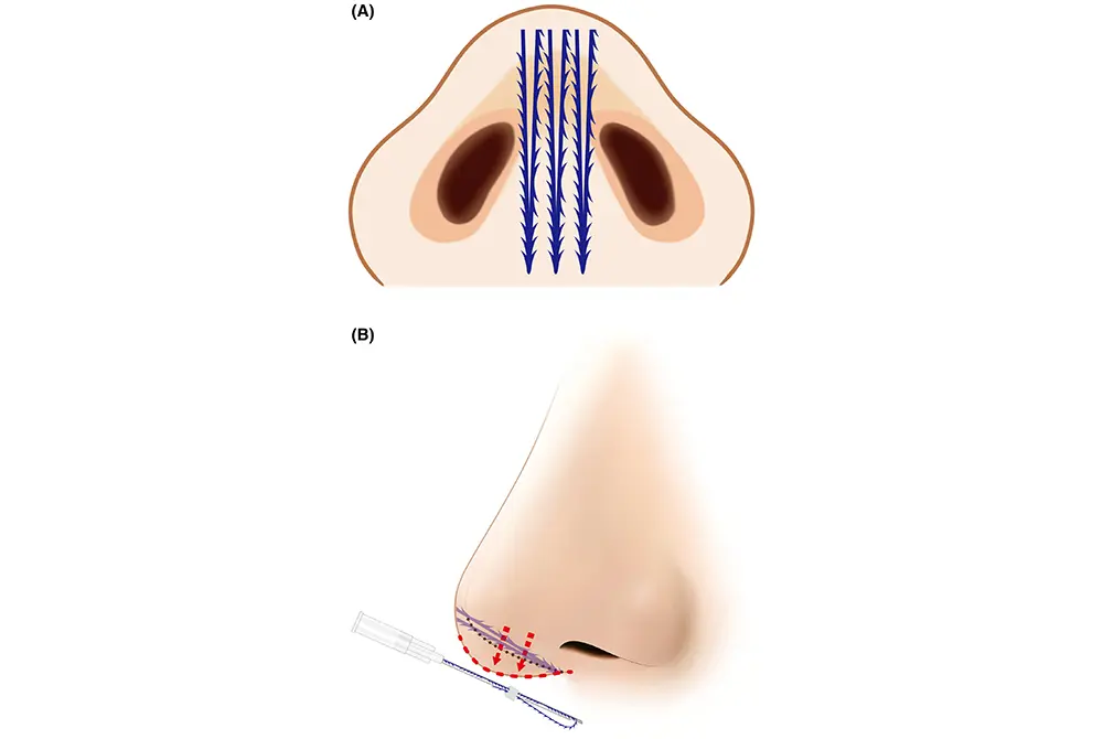 コグ付きスレッドを使った隆鼻術。スレッドにギザギザがある。（出典／J Cosmet Dermatol
. 2024 Sep 1. doi: 10.1111/jocd.16542. Online ahead of print.）