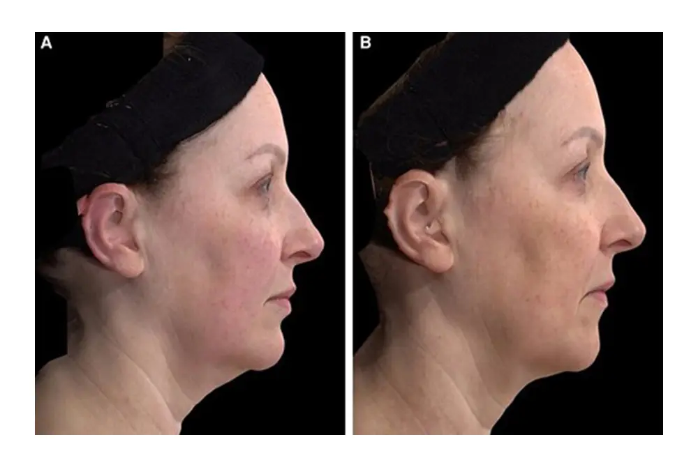 レヌビオン施術前（左）と施術後（右）。（写真／Aesthet Surg J
. 2023;43:1174-1188.）