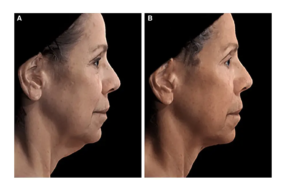 レヌビオン施術前（左）と施術後（右）。（写真／Aesthet Surg J
. 2023;43:1174-1188.）