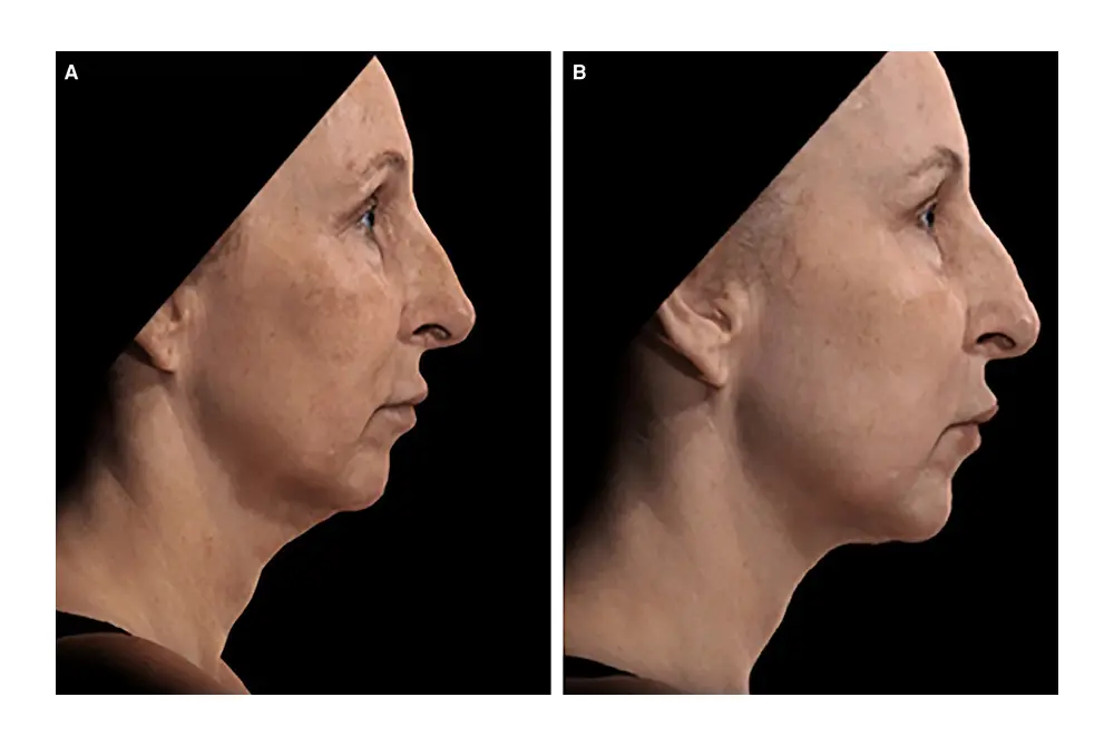 レヌビオン施術前（左）と施術後（右）。（写真／Aesthet Surg J
. 2023;43:1174-1188.）