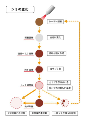 レーザー治療を受けてもシミは再発するの シミ再発のリスクと対策 美容ヒフコ