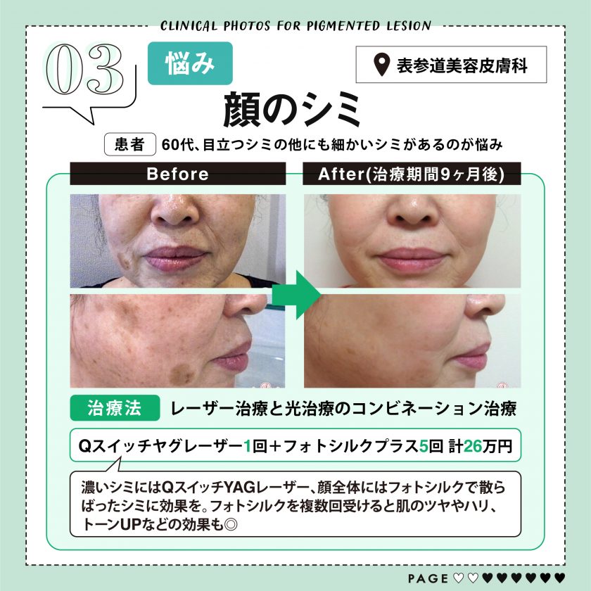 表参道美容皮膚科のシミ治療症例