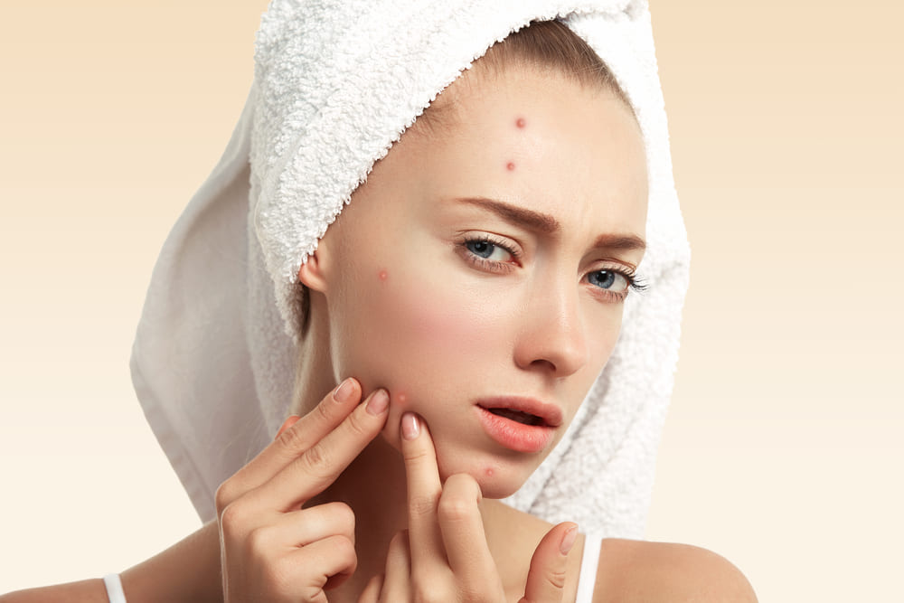 ニキビ跡を早く消す方法は 市販薬と皮膚科での治療の違いも解説 美容ヒフコ