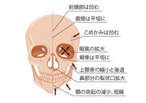加齢による顔面骨の萎縮